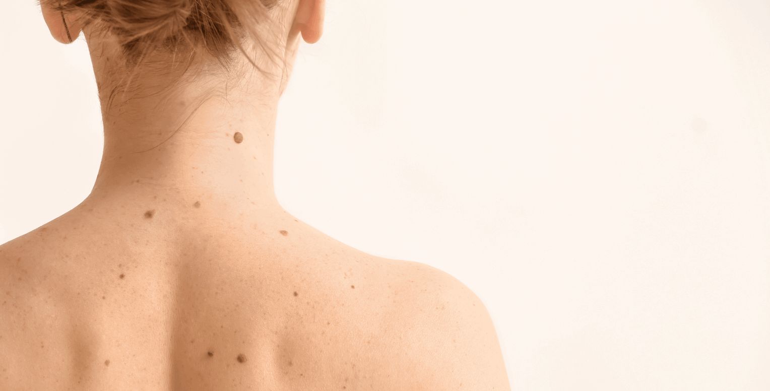 curatief-behandelen-melanoom